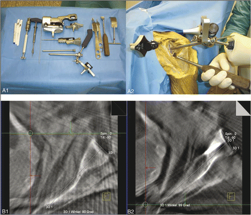 Figure 3. Top: Equipment for the navigated procedure (A1) and intraoperative guidance (A2). Bottom: 3D fluoroscopic assessment of the shoulder joint preoperatively (B1) and after navigated eccentric reaming of the glenoid (B2).