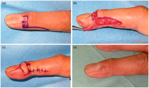 Figure 2. (a) Nail grooving deformity was observed. Design of tumor excision and flap. (b) View of flap elevation. The flap was harvested with fat. (c) View of flap fixation. (d) Three years postoperatively, tumor recurrence was not observed.