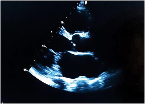 Figure 3 Parasternal long axis showing dilated left ventricle and atrium.