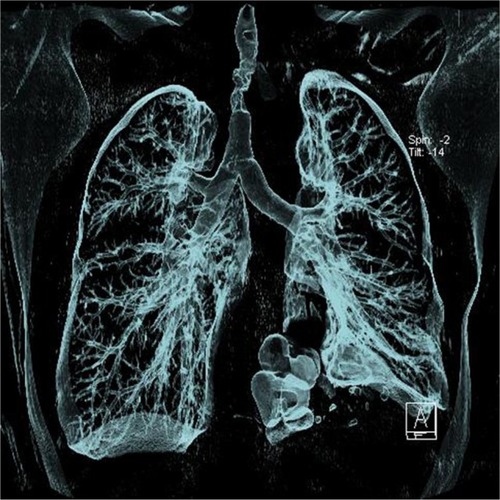 Figure 1 Three-dimensional imaging of the airway showing significant stenosis in the middle of the trachea and atelectasis in the lower left part of the lung.