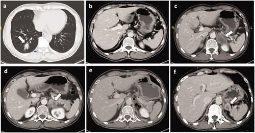 Figure 3. Recurrence after resection of the adrenal metastases. Four months after radical resection of right-lower lung cancer(pT2aN0M0), the 59-year-old male patient was founded with a right adrenal metastasis (size: 40mm × 29mm). (a) The primary lung tumor. (b) No tumor nodule was found in the right adrenal gland before pulmonary tumor resection. (c, d) The right adrenal metastasis. According to suggestion of the MDT, the patient received the right adrenal tumor resection (e). However, right adrenal metastasis (size: 29mm × 22mm) recurred 3 months after adrenal resection (f).