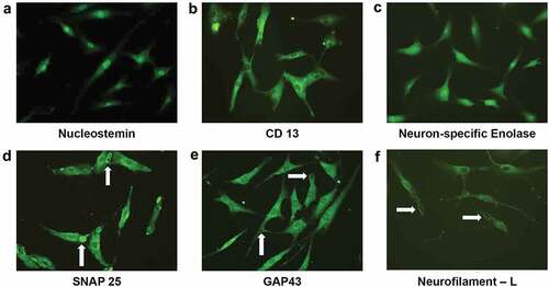 Figure 5. Immunocytochemical analysis on d 11 after neural induction revealed a neuroprogenitor-like stage. The proliferative marker Nucleostemin is present in the nuclei of NPCs (a). Aminopeptidase N/CD13 is concentrated around the nuclei of NPCs (b). The pan-neural protein Gamma enolase/Neuron-specific enolase is widely expressed in NPCs (c). The T-SNARE protein SNAP25, which promotes membrane fusion, is present in the growth cone and vesicles in NPCs (white arrow denotes membrane fusion) (d). Neuromodulin/GAP43 is present in the growing tips (white arrow) of the elongated axons of NPCs (e). The intermediate filament NF-L is concentrated around the nuclei and is also present in the growth cones (solid white arrow) of NPCs (f). (magnification20x). Figure 6. Semi-quantitative gene expression profiling by RT-PCR of ADSC-derived neural-lineage cells for three neural-induced samples from patients S1-3 at d 25 after induction with two different treatments: NIM with β-ME (WBME) and without β-ME (W/O BME). Untreated ADSCs used as control.