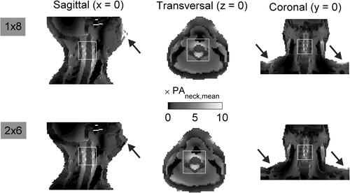 Figure 3. Cross-sections of the PA distributions in the large patient model in HT position for one ring of eight dipoles (1 × 8, R = 20 cm) and two rings of six dipoles (2 × 6, R = 20 cm, D = 6 cm). Black arrows indicate the locations of PA hotspots (1 × 8) or corresponding locations where these hotspots are reduced (2 × 6).