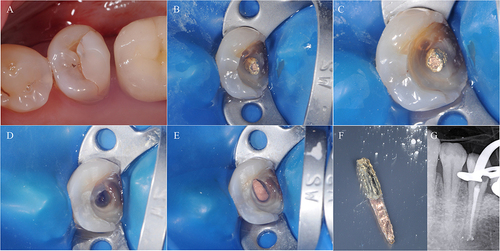 Figure 3 Clinical example of prefabricated metal post removal associated with a composite core.