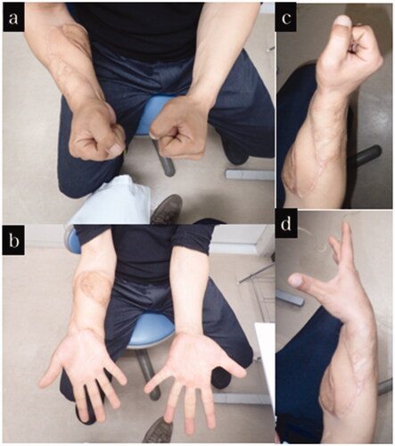 Figure 7. Final appearance and range of motion of case 3. (a–d) Appearance and range of motion at one year after the injury.