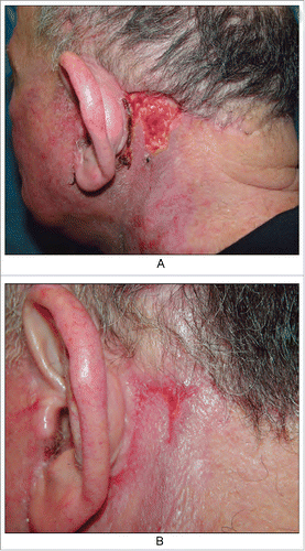 Figure 2. We emphasize repeated inflammation stimulates to the granulation tissue hyperplasia in the area without suture, so leaving scars after healing. (from Bolognia JL,Jorizzo JL,Schaffer JV .Dermatology (3rd Edition). Amsterdam(NL):Elsevier;2012.p2315.Fig.141.4)