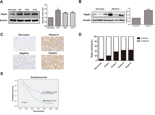 Figure 1 Rap2c is up-regulated in glioma cells and tissues and influences the 5-year overall survival in glioma patients. (A) Protein expression of Rap2c in normal astrocytes and glioma cells (U87, U251, U118) determined by Western blotting. (B) Protein expression of Rap2c in normal brain tissues and glioma tissues quantified by Western blotting. (C) Rap2c protein expression in glioma tissue (Grade IV) and normal brain tissue as measured by IHC assay. Original magnifications, ×400. Scale bar, 20 μm for C. (D) Correlation between Rap2c expression and malignant progression of glioma. (E) Kaplan-Meier survival analysis of 180 glioma patients with low and high Rap2c expression (P<0.05, Log rank test), *P< 0.05; **P< 0.01.