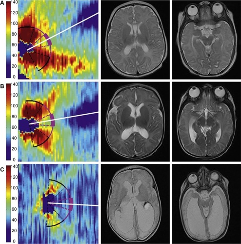 Figure 5 Very preterm infant RNFL thickness maps at term equivalent age (left column) and their corresponding near-term T2-weighted brain MRI (B, right columns).