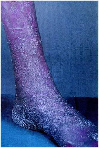 Figure 10. Frostbite of the lower leg and foot. Reprinted with permission from: Oumeish and Parish [Citation40], with permission from Elsevier.