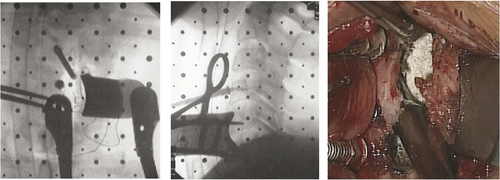 Figure 1. The longus colli muscle was retracted by a lateral blade connected to one of the central screws. Left: Anterior-posterior view with C-arm. Center: Lateral view with C-arm. Right: Microscopic view during contralateral-side drilling.