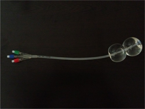 Figure 1 Cervical ripening catheter.
