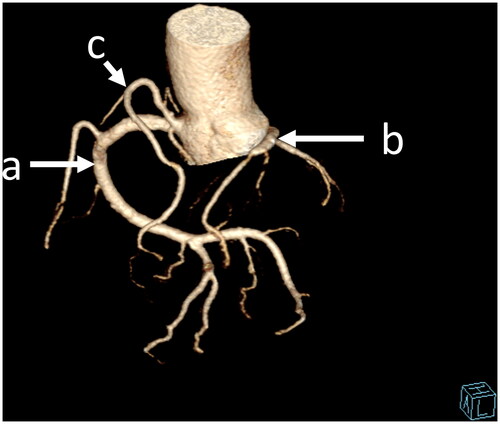 Figure 3. The last CCTA image, which shows right coronary artery(a) and two vessels (b,c) coming from the dominant one.