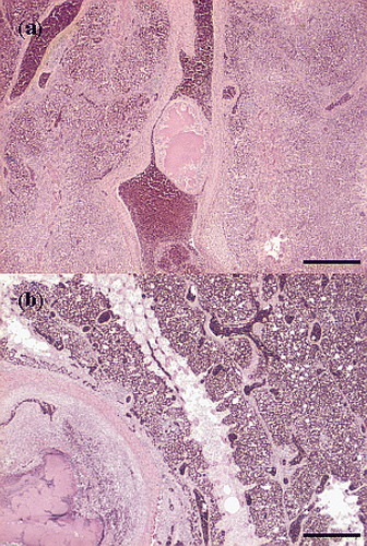 Figure 5. Haematoxylin and eosin sections of thrombotic lesions in the A. pulmonalis of the lungs from birds with E. hirae-associated endocarditis, with (a) thrombosis and endarteritis of a large branch of the A. pulmonalis, with mural attachment, containing accumulations of small cocci (bar = 500 µm), and (b) thrombosis and endarteritis in a large branch of the A. pulmonalis: the smaller branches of the A. pulmonalis following the subdivisions of the bronchi and the capillary network in the parabronchi are unaffected (bar = 500 µm).