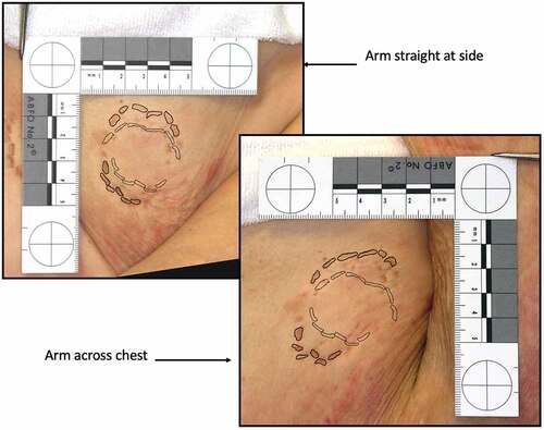 Figure 2. The bite is outlined in black. The set of teeth that created the bite is illustrated inside the bite. Notice the distortion that results when the body part is moved.