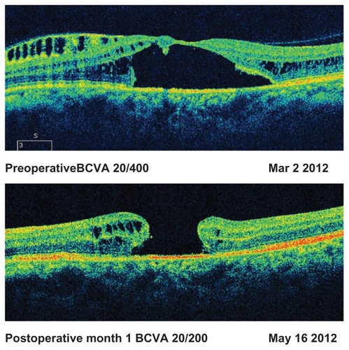 Figure 6 Development of macular hole after surgery.(Patient 18, Table 3)