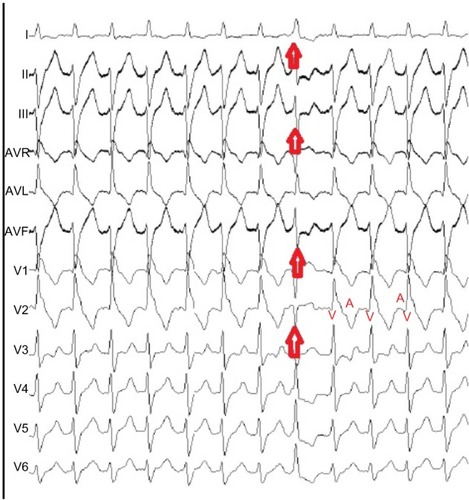 Figure 1 Surface ECG recording taken during clinical ventricular tachycardia.