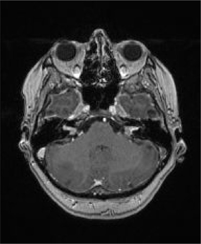 Figure 1 Brain axial magnetic resonance imaging T1-weighted sequence after gadolinium intravenous administration showing thickening and enhancement of bilateral vestibulocochlear nerves and solitary lesion in right cerebellar hemisphere.