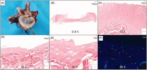 Figure 5. Ablated area of the vertebral growth plate. (A) Visual inspection. (B) Hematoxylin and eosin (HE) section overview. (C) Normal vertebral growth plate on HE staining clearly showing cell layers. (D,E). Ablated vertebral growth plate on HE staining showing that the reserve and proliferation layers were absent and only the hypertrophic layer remained in the ablated area. (F) TUNEL immunofluorescence staining showing chondrocyte apoptosis in the ablation area (The red circles show necrosis of chondrocytes, and the blue circles show no necrosis of chondrocytes).