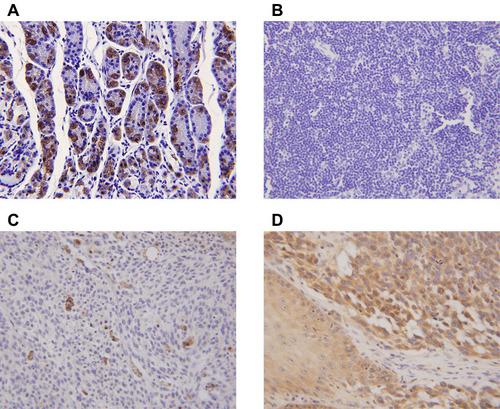 Figure 5 Expression of the β-subunit of H+/K+-ATPases (proton pumps) in laryngeal carcinomas as revealed by immunohistochemical staining. (A) Gastric control tissues exhibited strong staining for the β-subunit. (B). The β-subunit was not expressed in paracarcinoma tissues. (C) The β-subunit was not expressed in laryngeal carcinomas. (D) Positive staining (brown) is evident in both the cytoplasm and plasma membrane of laryngeal carcinoma cells.