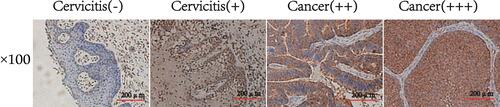 Figure 3 ZNF582 protein expression in cervicitis and cervical cancer tissues by immunohistochemistry. From left to right, Low expression of ZNF582 in a cervicitis tissue, high expression of ZNF582 in a cervicitis tissue, higher expression of ZNF582 in a cervical cancer, highest expression of ZNF582 in a cervical cancer. The microscope magnification is 100.
