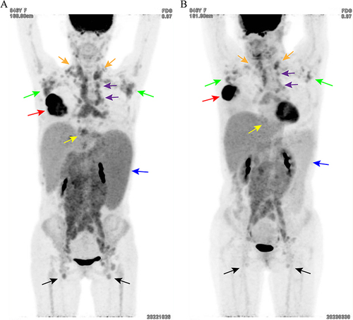 Figure 2 Whole-body PET-CT before (A) and after (B) neoadjuvant therapy. After treatment, the right breast mass (red arrows) significantly decreased in size. Bilateral cervical (Orange arrows), bilateral axillary (green arrows), mediastinal (purple arrows), cardiophrenic (yellow arrows), intraabdominal, intrapelvic and bilateral inguinal (black arrows) LNs decreased in both size and 18F-FDG uptake. A significant decrease in size and 18F-FDG uptake was also detected in spleen (blue arrows).