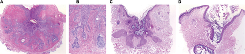 Figure 4 Tumors with dilated pore.