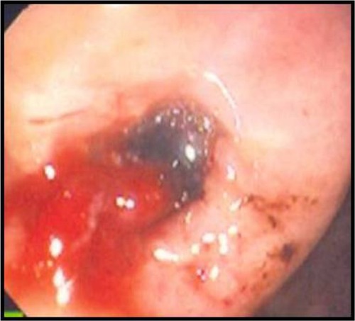 Figure 1 Endoscopic image of a 1×1 cm hemorrhagic gastric ulcer in the antrum with a visible vessel revealed by endoscopy.