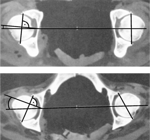 Figure 2. Retroversion of pelvis (lower graph) results in increasing anteversion of the acetabulum.
