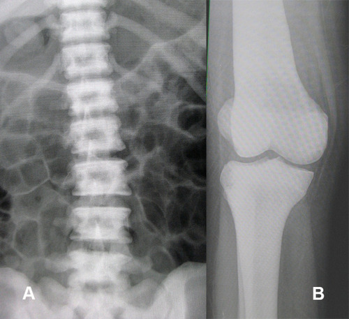 Figure 2 Anteroposterior radiograph of the lumbar spine (A) showed the appearance of a “rugger jersey spine ”caused by thickening of vertebral endplates. Anteroposterior radiograph of right knee (B) showed no “Erlenmeyer flask” deformity of the distal femur.
