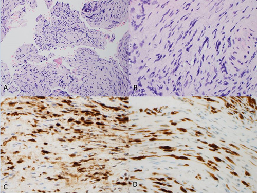 Figure 2 Biopsy of the right cavernous sinus lesion. The biopsy of the right cavernous sinus lesion comprises multiple fragments of nerve with the diffuse interstitial infiltrate of large, atypical cells (A and B, x 20 and x 40; respectively). The large, atypical cells are diffusely positive for PAX-5 (C, x 40) and CD20. The proliferative rate by Ki-67 is high (80%) (D, x 40). The findings confirmed a high-grade B cell lymphoma involving the cranial nerve.