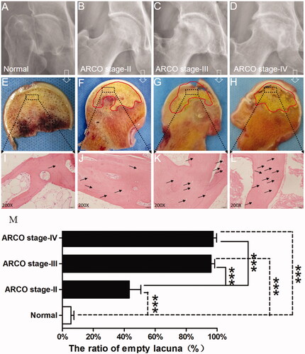 Figure 1. (A–D) X-ray images of control subject and SIONFH patients with different ARCO stages. Subchondral bone fracture, flattened femoral head, articular gap narrowing and cartilage destruction were closely related to ARCO stage. (E–H) Bone samples from the control group and SIONFH group with three ARCO stages. The black frame indicates that the regions were collected for further analysis. (I–L) Histopathological features of control and SIONFH bone. (M) The number of empty lacuna increased with ARCO stage and was significantly higher in the SIONFH group compared with control subjects. *** Represents p<.001.