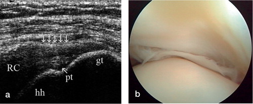 Figure 3. Partial-thickness tear of the rotator cuff, (a) lateral longitudinal view by ultrasound and (b) arthroscopic view.pt, partial tear;5 arrows, contour concavity (for other abbreviations, see Figure 1).