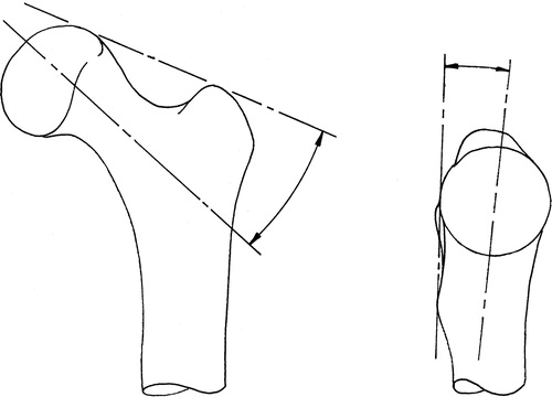 Figure 1. Preoperative planning of varus–valgus angle (left) on AP radiograph and anteversion angle (right) on ML ratiograph.