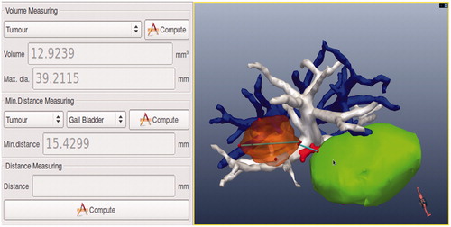 Figure 3. Tumour volume, maximum diameter of the tumour, and minimum distance from the tumour to surrounding duct system are calculated from the 3D image navigation software and displayed.