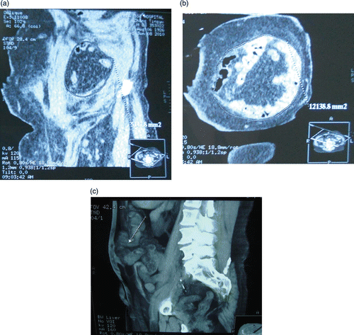 Figure 1. (a) Marking the section of the hernia ring. (b) Measuring the area of the hernia ring. (c) Hernia on the norma sagittalis.