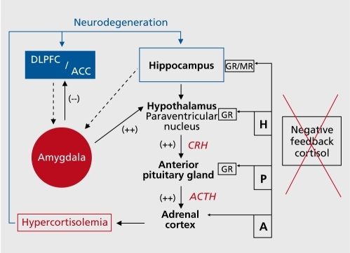 Figure 1. Theoretical framework of deregulated cortico-thalamiclimbic pathways in unipolar major depression. In major depression there is a pronounced shift in the homeostasis with diminished activity in the prefrontal cortex (DLPFC and dorsal ACC - blue), enhanced activity in the amygdala (red) and activation of the core stress system. Hyperactivity in limbic areas results in higher neural activities at the hypothalamic level, evoking higher corticotrophin-releasing hormone (CRH) secretions, resulting in elevations of cortisol levels. Hippocampal dysfunction may also result in reduction of the inhibitory regulation of the HPA axis, which could then lead to hypercortisolemia.Citation18 The failing negative feedback system results in chronic hypercortisolemia. In long-term depressive episodes, chronically elevated levels of cortisol contribute to hippocampal and cortical atrophyCitation27 and reducing hippocampal ability to inhibit amygdala hyperactivity.Citation76 Abnormal modulation of cortical-hippocampal-amygdala pathways may contribute to chronically hypersensitive stress responses, mediating features of anxiety, anhedonia, and affective dyscontrol.Citation76 Additionally, the dysfunctional ACC fails to serve its inhibitory role in emotional regulation on the amygdala, resulting in further motivational and affective disruption.Citation77 DLPFC, dorsolateral prefrontal cortex; ACC, anterior cingulate cortex; ACTH, adenocorticotropic hormone; HPA, hypothalamic-pituitaryadrena