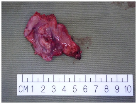 Figure 5 Photo of the radical tonsillectomy specimen.