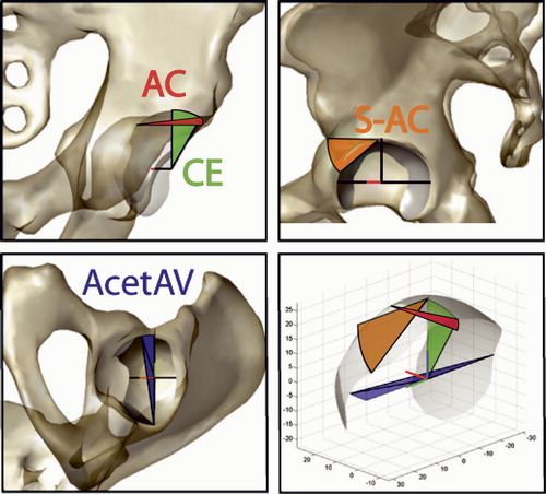 Figure 1. Angles describing the orientation of the acetabulum and femoral coverage are calculated from a 3D segmented model of the pelvis in frontal, sagittal, and transverse planes emulating those traditionally measured from radiographs or reformatted CT scans. In the frontal plane (top left), the AC angle measures the obliqueness of the acetabular roof between the medial aspect of the sourcil, the lateral edge of the acetabular rim, and a horizontal line. The CE angle measures the coverage of the lateral edge of the acetabulum with respect to the center of the femoral head (not shown), and may have a negative value in severely dysplastic cases. The orientation of the acetabular cup (S-AC angle) in the sagittal plane (top right) is measured from the most superior aspect of the acetabular roof to the most anterior aspect with respect to horizontal. The anteversion (AcetAV angle) is measured on a transverse plane (bottom left) viewed inferior to superior using a line created between the posterior and anterior rim of the acetabulum. The angle is measured with respect to a line normal to the two femoral head centers (intercapital centerline). The angle measurements help to characterize the orientation of the load-bearing surface of the hip joint in 3 dimensions (bottom right) during realignment (axis scale in mm; viewed isometric from anterio-lateral-superior).