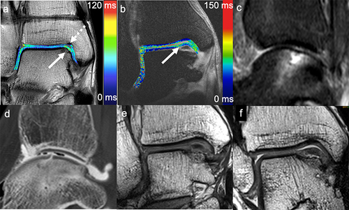Figure 7 Cross-sectional imaging of osteochondral defects. (a) Coronal T2 multi-slice multi-echo spin-echo sequence in a patient after suture-button fixation for syndesmotic instability. Color-coded cartilage T2 map overlaid on first echo image. Osteochondral defect with higher T2 values at the medial talar dome (arrow). The Notch of Harty at the anteromedial tibia (dotted arrow). (b) Patient with an osteochondral lesion at the medial talar dome. Coronal multi-slice multi-echo T1rho cartilage color maps overlaid on first echo image demonstrate increased cartilage relaxation times in the osteochondral lesion (arrow). (c) Sagittal STIR MRI sequence of a patient with an osteochondral lesion at the talus (same patient as d). Subchondral BME is nicely depicted while the presence of a chondral defect can only be suggested. (d) CT arthrography of the same patient as c. The fissural osteochondral defect that causes the BME can be appreciated. (e) Coronal reconstructions of 3D IMw TSE images of a patient with an osteochondral lesion at the medial talar dome (same patient as b and f). Without traction a grade 2 lesion without fragment loosening is assumed. (f) Coronal reconstructions of 3D IMw TSE images of the same patient as in b and e with axial traction of the ankle. Images with axial traction reveal subchondral delamination with fluid interposition leading to classification grade 3 and representing an indication for surgical cartilage repair.