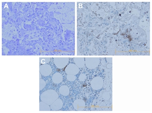 Figure 2 Pathological findings. (A and B) Findings of histological examination of the lung: (A) result of hematoxylin and eosin staining revealed diffuse alveolar damage with hyaline membrane formation (×200), (B) result of immunostaining for CD41 demonstrated the sequestration of platelets in the lung (×200). (C) Positive control of immunostaining for CD41 (normal bone marrow) (×200).