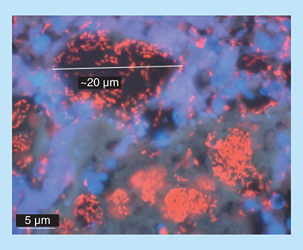 Figure 14.  Biofilm aggregates of Pseudomonas aeruginosa in a chronic infected cystic fibrosis lung. Using a specific P. aeruginosa PNA fluorescence in situ hybridization probe, the bacteria are visualized in red, whereas the inflammatory cells surrounding the biofilm patches are counterstained with 4',6-diamidino-2-phenylindole, DAPI (blue).Reproduced with permission from [Citation158] © Wiley-Liss, Inc. (2009).