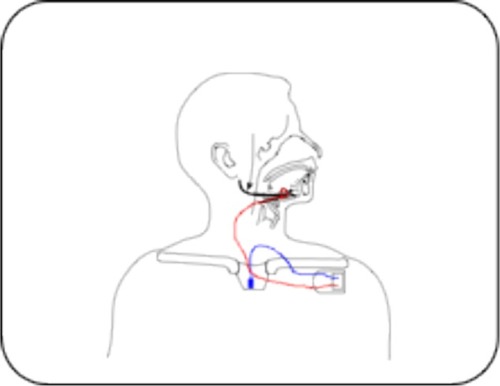 Figure 3 Schematic representation of the Inspire™ I system for hypoglossal nerve stimulation in patients with obstructive sleep apnea. The stimulator (implantable pulse generator) is connected to the respiratory sensor by means of a sensor lead. A stimulation lead connects the stimulator to the half-cuff electrode around the hypoglossal nerve.