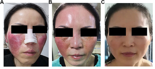 Figure 1 The facial flushing Changes during treatment. (A) bilateral facial flushing before therapy; (B) state after stellate ganglion block; (C) facial flushing was markable improved by venlafaxine.