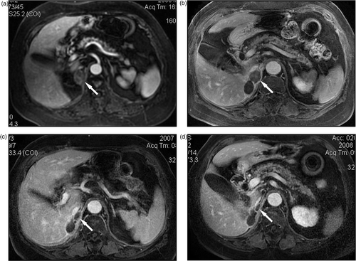 Figure 2. MW ablation in a 76-year-old woman who had a right adrenal metastasis from clear-cell renal carcinoma two years after right nephrectomy. (a) Before treatment the tumour was slightly enhanced on contrast-enhanced MRI. No enhancement was observed on contrast-enhanced MRI at three months (b), one year (c) and two years (d) after MW ablation, the ablated tumour gradually shrank over time.