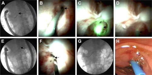 Figure 4 Endoscopic treatment of pancreatic duct stricture and APBJ.