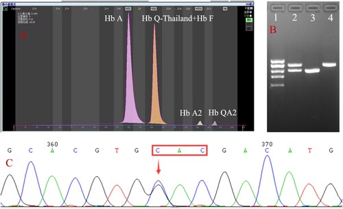 Figure 1. Hb analysis by CE showed an abnormal peak migrating to zone F (A). Results of agarose electrophoresis of Gap-PCR amplification products (B): 1. DL2000 (from top to bottom: 2.0, 1.7, 1.4, 1.2, 0.9 kb), 2. -α4.2/αα, 3. -α4.2/-α4.2, 4. Normal. A mutation of GAC>CAC in a heterozygous state was observed at codon 74 of the HBA1 gene using Sanger sequencing, corresponding to Hb Q-Thailand (C).