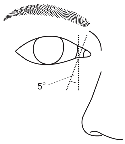 Figure 1 Diagram of the incisional lines. One incision is done sagittally from the lower lacrimal punctum; the other is done at 5 degrees lateral inclination to the sagittal plane.