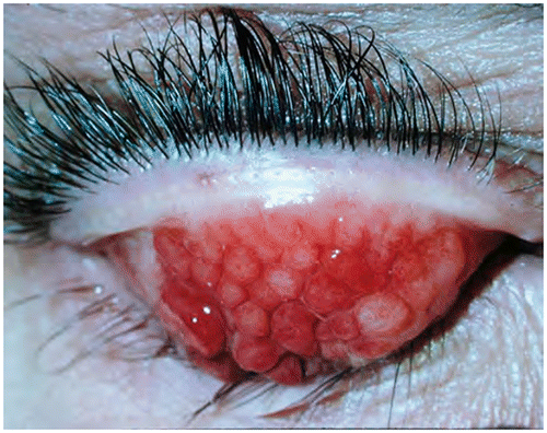 Figure 14: Everted upper lid with giant papillary conjunctivitis