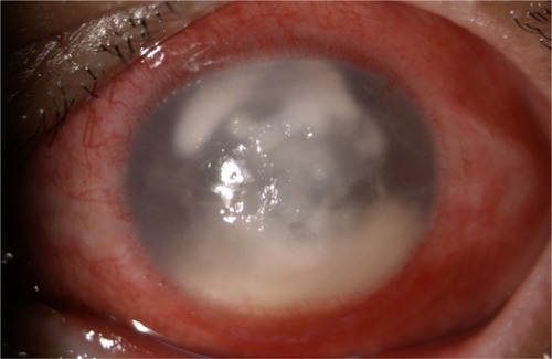 Figure 1 Biomicroscopic photograph of left eye demonstrating central corneal infiltration with hypopyon.