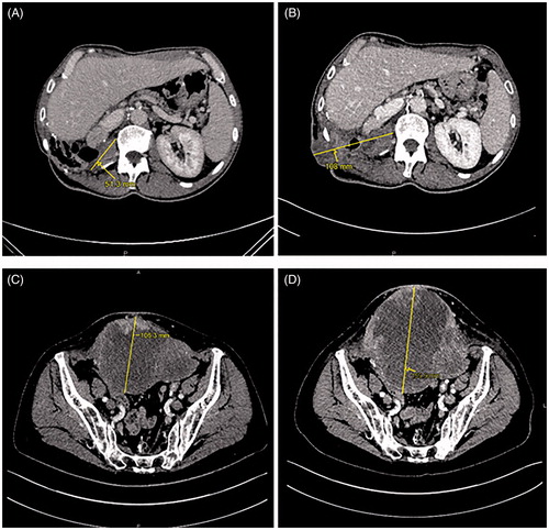 Figure 1. An increase in the size of a necrotic mass in the surgical bed of the primary tumor with cutaneous fistula in the right flank on computed tomography (CT) scan for restaging in April 2020 (B) compared to that in January 2020 (A) in case 1, and an increase in the size of a necrotic peritoneal carcinomatous mass with cutaneous infiltration in October 2017 (D) compared to that in January 2017 (C) in case 2.